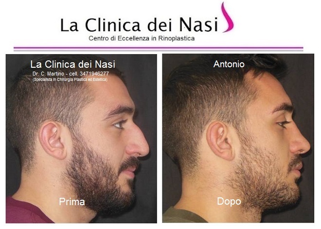 Prove di stadi di alcolismo a donne
