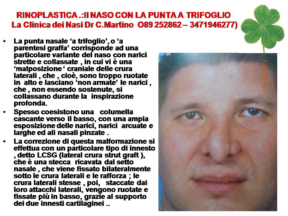 IL NASO CON LA UNTA A TRIFOGLIO