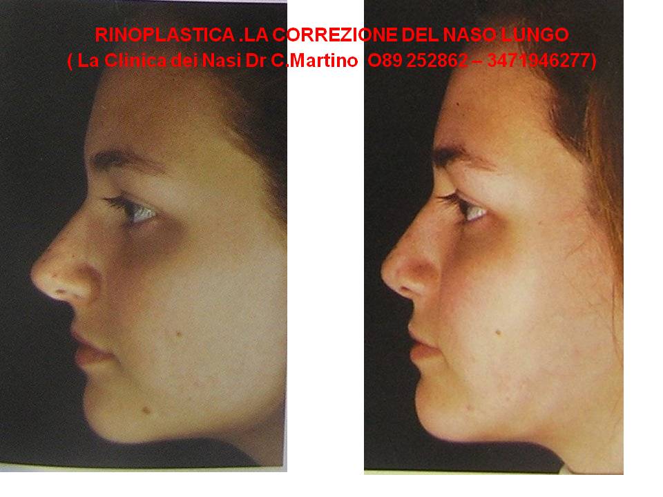 Rinoplastica Ridurre Lunghezza Del Naso Clinica Pallaoro