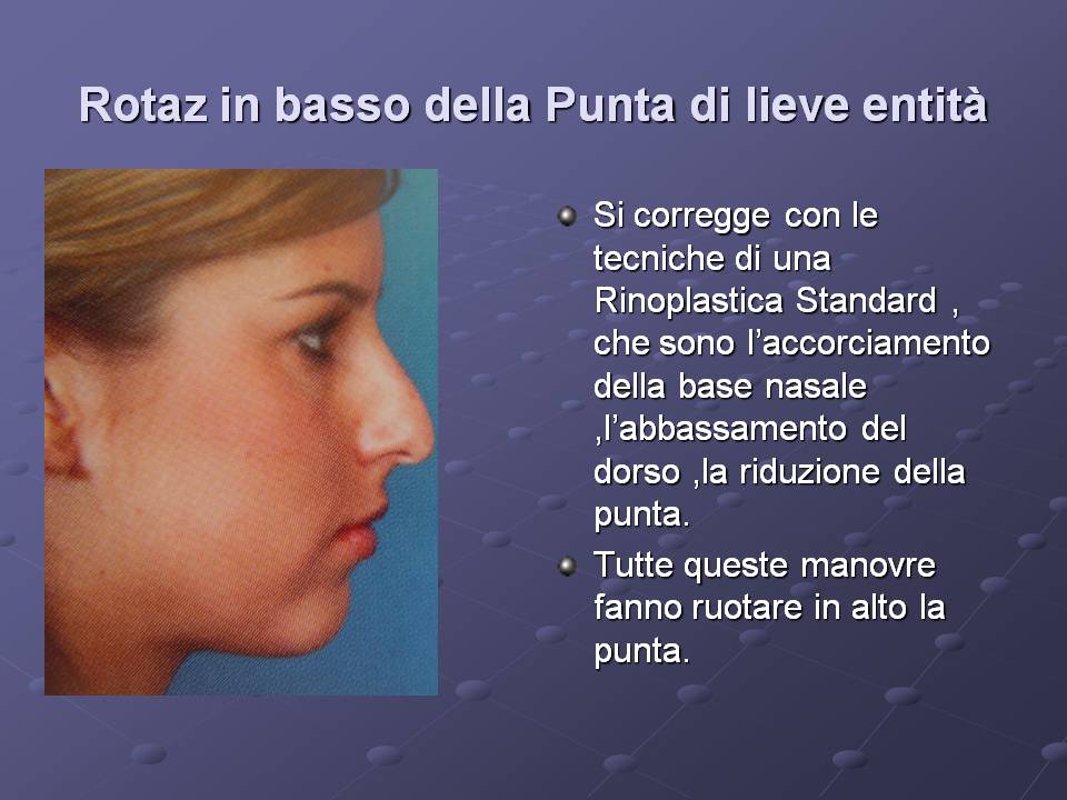 RINOPLASTICA : IL NASO CON LA PUNTA CADENTE