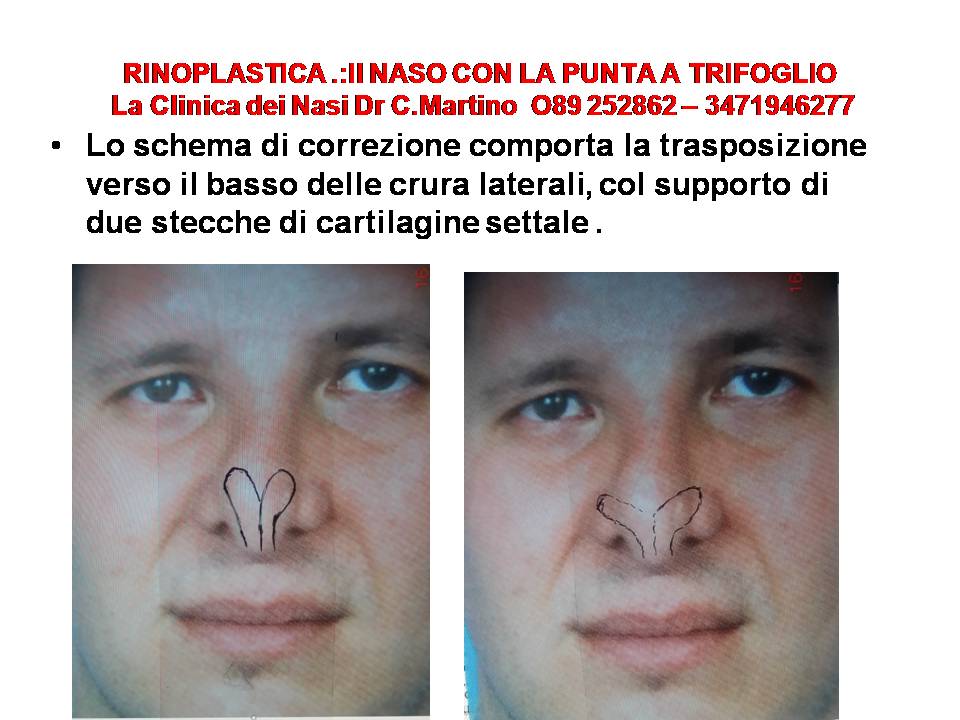 RINOPLASTICA: IL NASO CON LA PUNTA A TRIFOGLIO