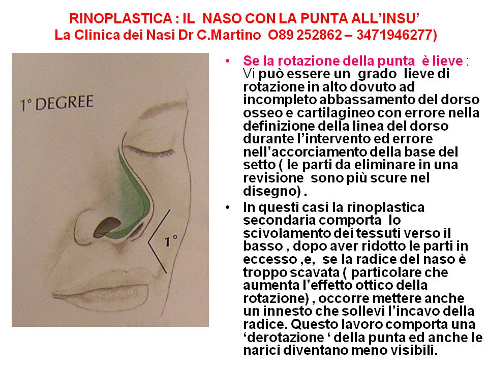RINOPLASTICA : IL NASO CON LA PUNTA ALL’INSU’