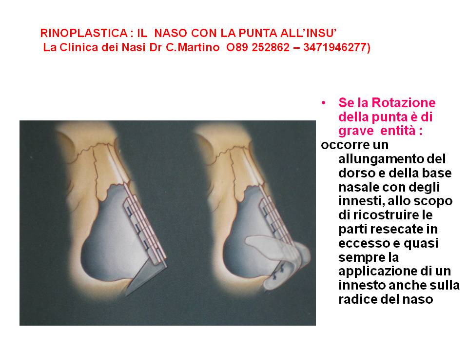 RINOPLASTICA : IL NASO CON LA PUNTA ALL’INSU’