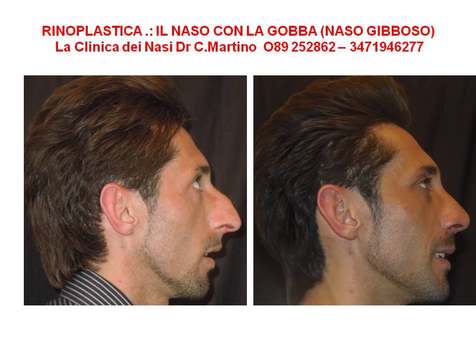 RINOPLASTICA LA CORREZIONE DEL NASO CON LA GOBBA (gibboso)