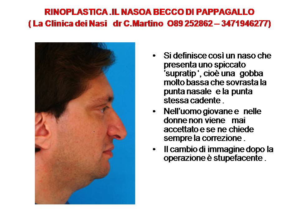 IL NASO A BECCO DI PAPPAGALLO