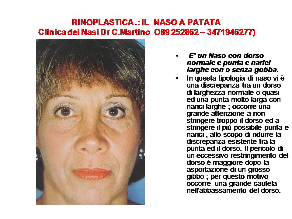 IL NASO A PATATA