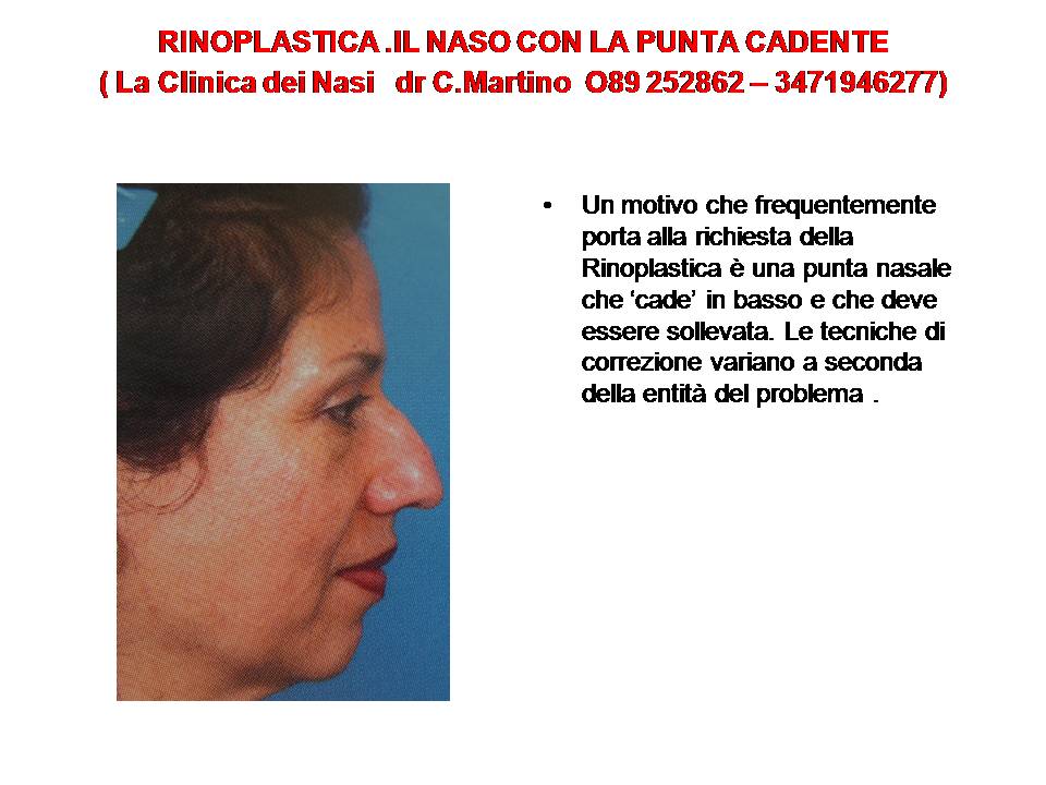 IL NASO A PUNTA CADENTE