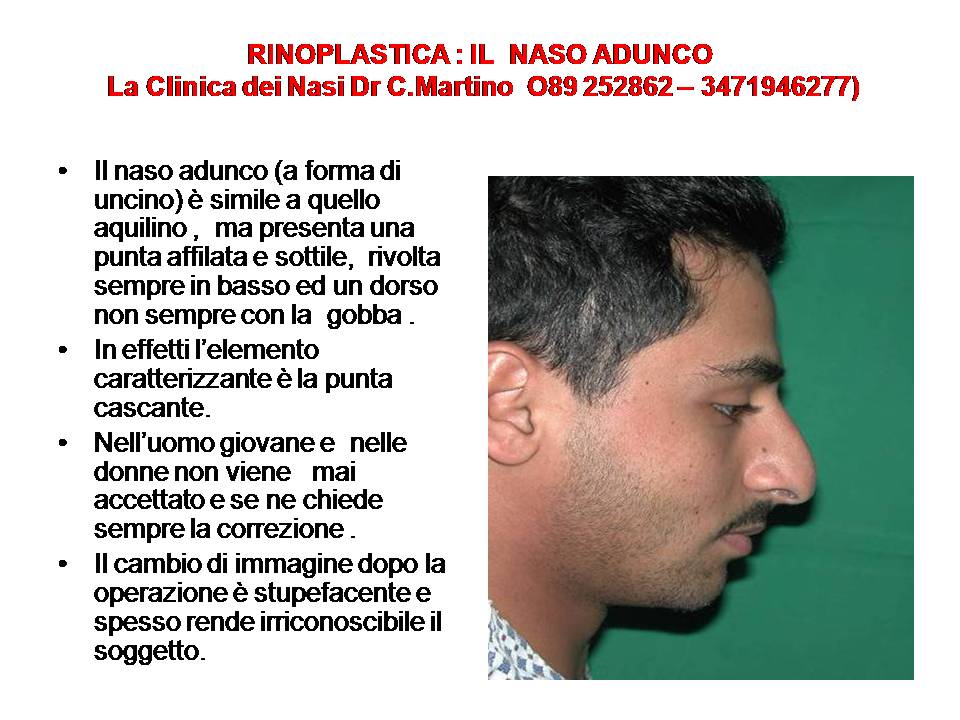 IL NASO ADUNCO
