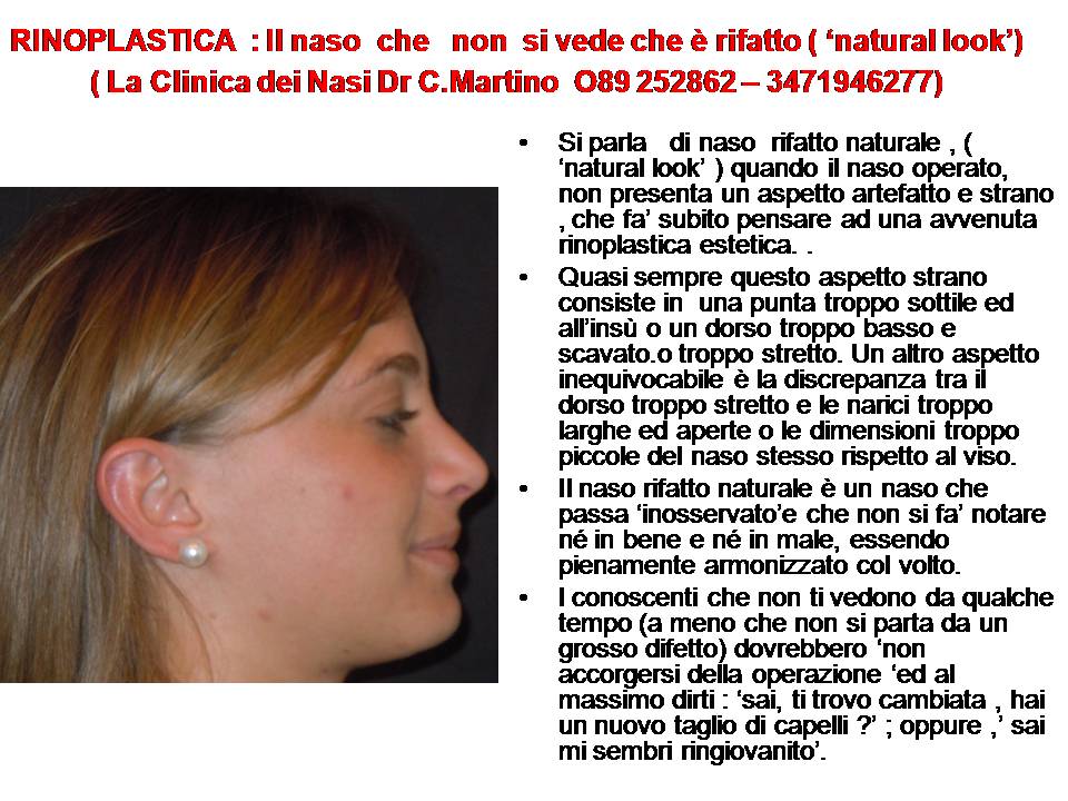 IL NASO CHE NON SI VEDE CHE E' RIFATTO