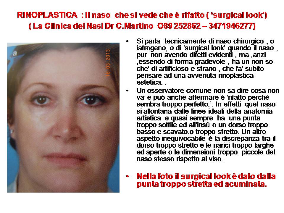 IL NASO CHE SI VEDE CH E' RIFATTO