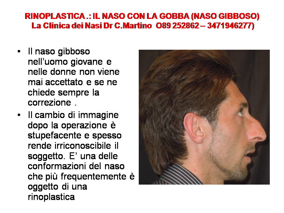 IL NASO CON LA GOBBA