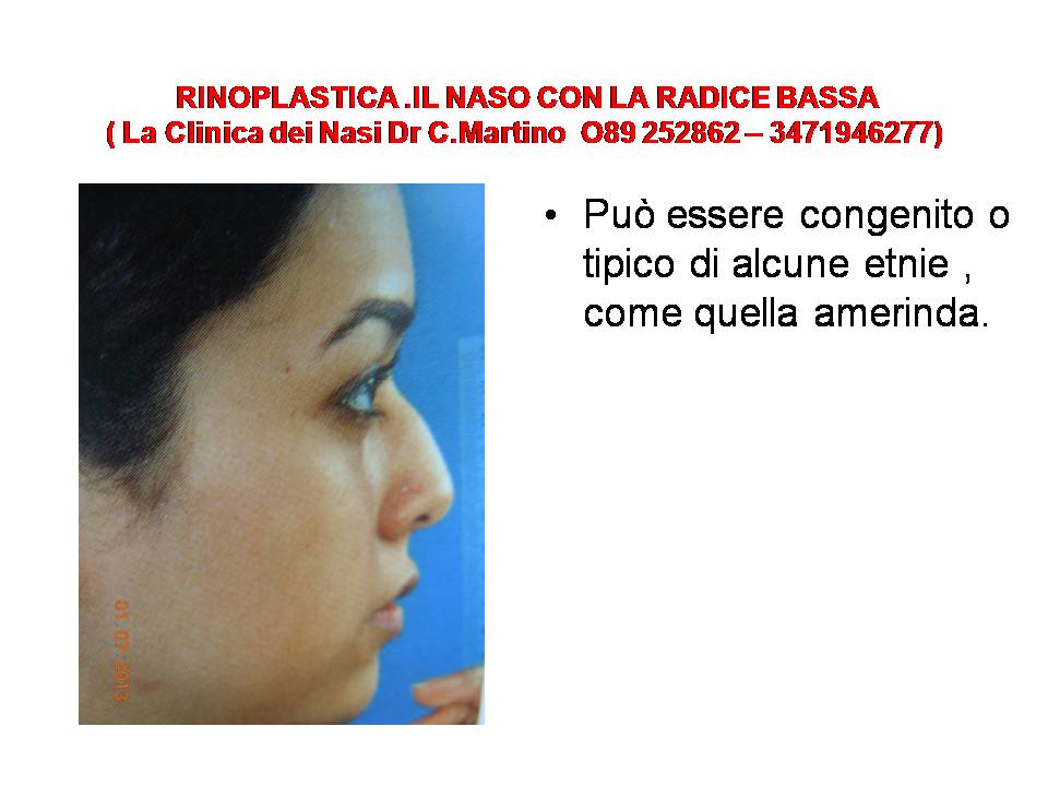 IL NASO CON LA RADICE BASSAS
