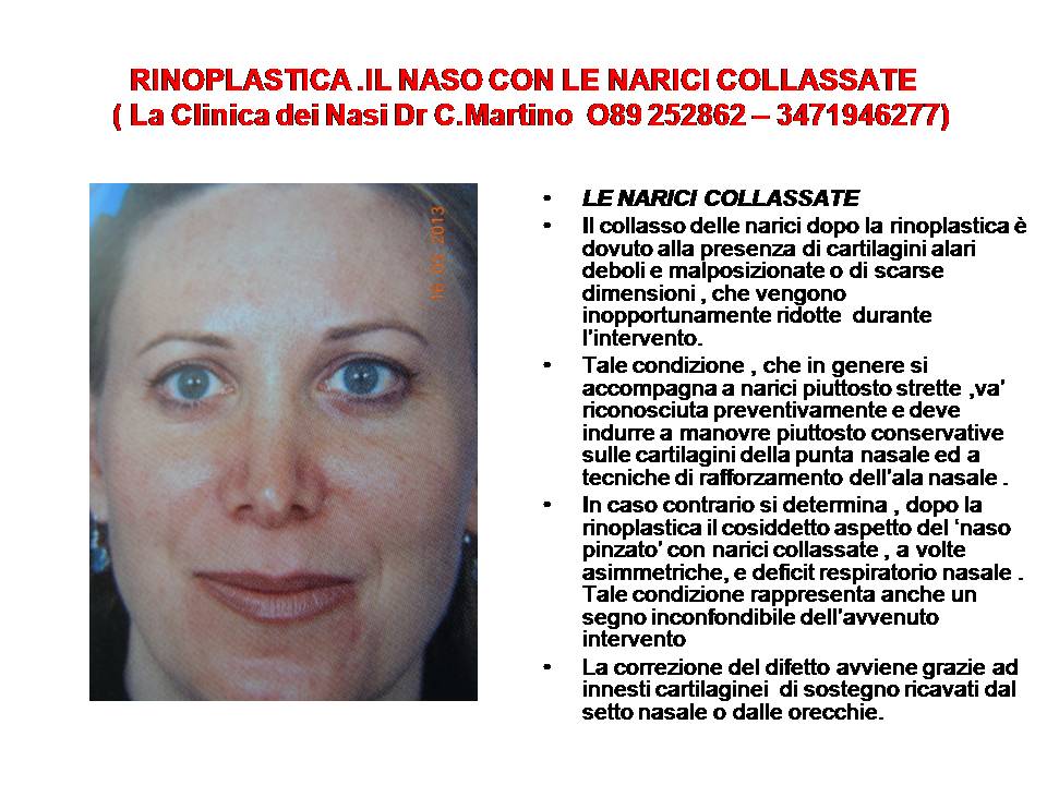 IL NASO CON LE NARICI COLLASSATE