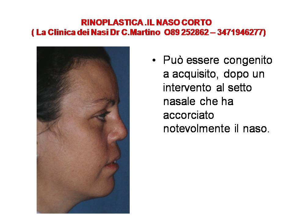 IL NASO CORTO ù