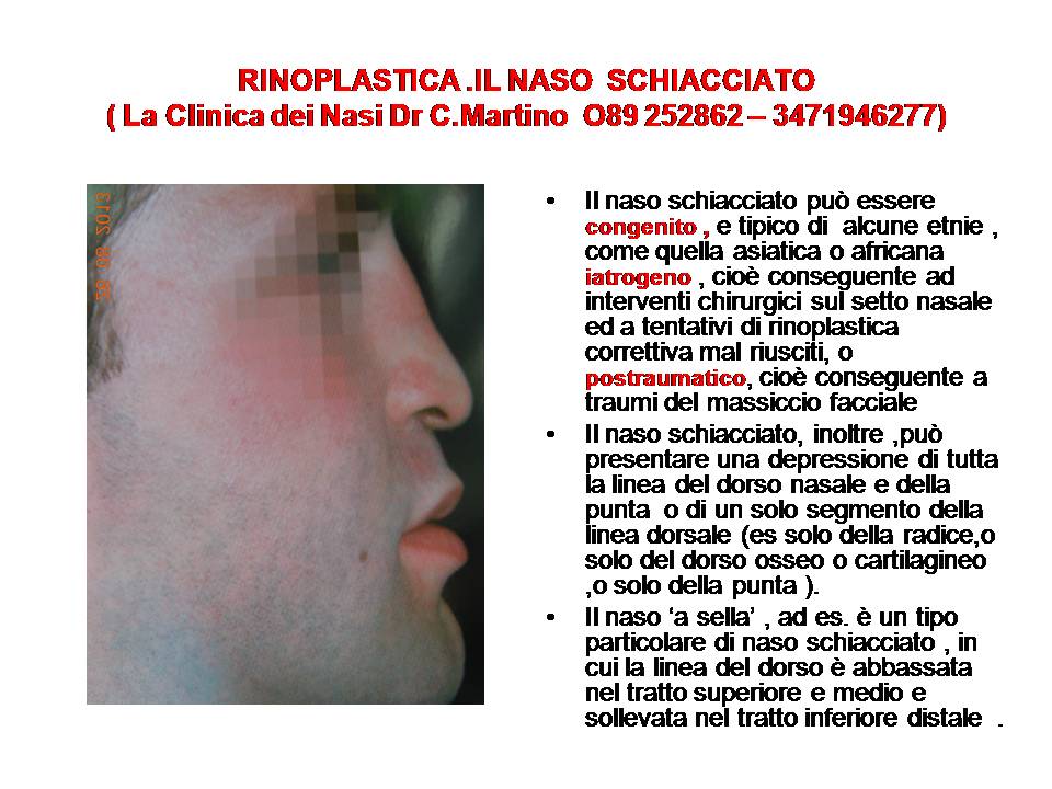IL NASO SCHIACCIATO