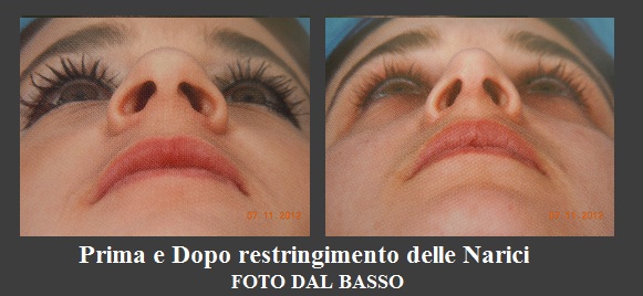 RINOPLASTICA LE NARICI E LA LORO FORMA 