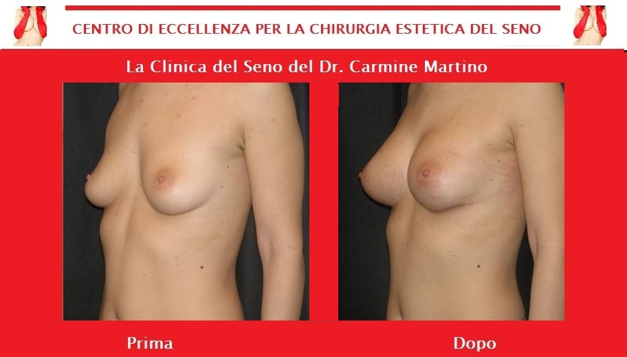 Aumentare un petto a casa
