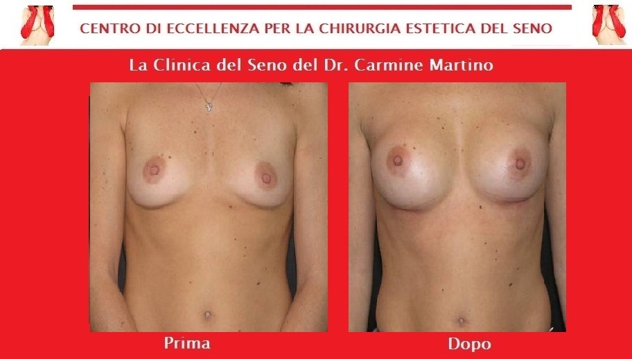 Aumento di adolescente di un petto