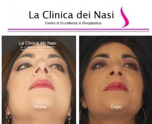 rinoplastica donna anonima 1000