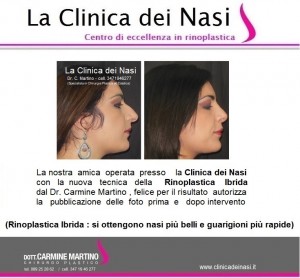 rinoplastica donna anonima 120