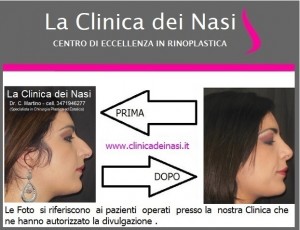 rinoplastica donna anonima 130