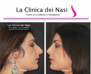 rinoplastica donna anonima 300