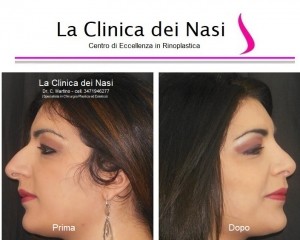 rinoplastica donna anonima 400