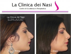 rinoplastica donna anonima 450