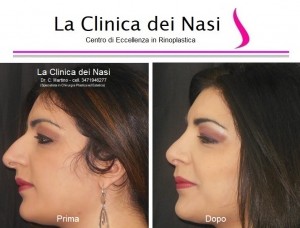 rinoplastica donna anonima 600