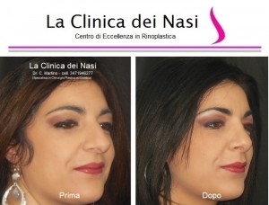 rinoplastica donna anonima 700