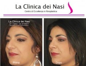 rinoplastica donna anonima 800