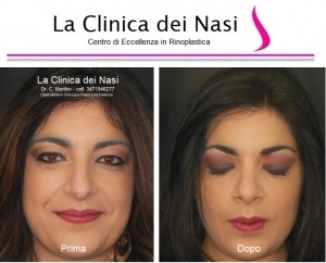 rinoplastica donna anonima 900
