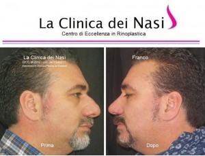 rinoplastica franco -002.4