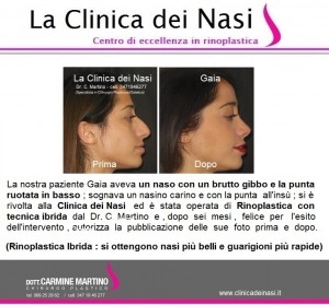 rinoplastica gaia 100
