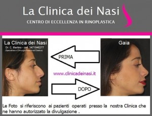 rinoplastica gaia 200