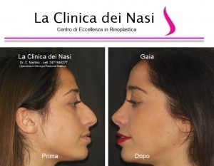 rinoplastica gaia 300