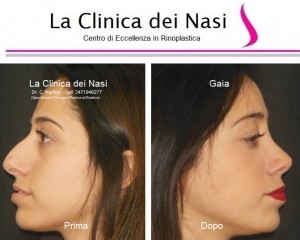 rinoplastica gaia 400