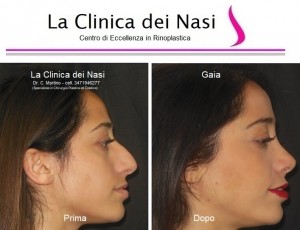 rinoplastica gaia 500