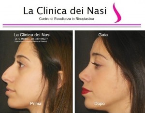 rinoplastica gaia 600