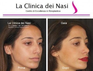 rinoplastica gaia 700