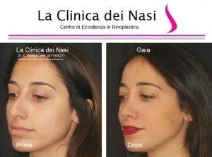 rinoplastica gaia 800
