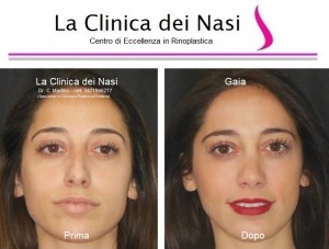 rinoplastica gaia 900