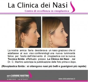 rinoplastica ilaria 10