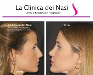 rinoplastica ilaria 20