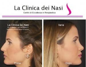 rinoplastica ilaria 30