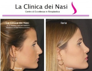 rinoplastica ilaria 40
