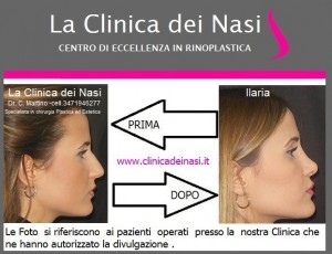 rinoplastica ilaria 5