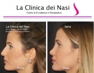 rinoplastica ilaria 50
