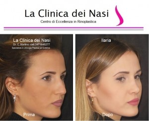 rinoplastica ilaria 60