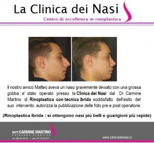 rinoplastica matteo 20